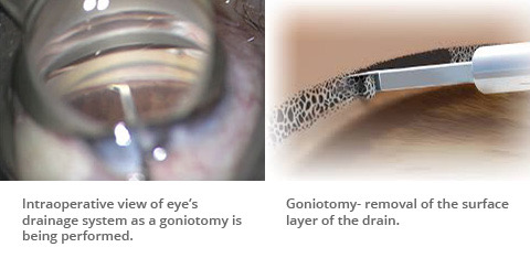 Vues perop&eacute;ratoires d'une goniotomie au Kahook Dual Blade&nbsp;: la micro-lame excise une bandelette de trab&eacute;culum dans l'angle irido-corn&eacute;en