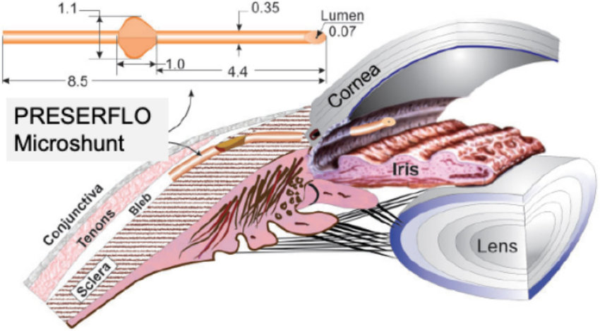 Sch&eacute;ma du PRESERFLO MicroShunt&nbsp;: le micro-tube d&eacute;rive l'humeur aqueuse depuis la chambre ant&eacute;rieure vers un espace sous la conjonctive, formant une bulle de filtration (bleb)