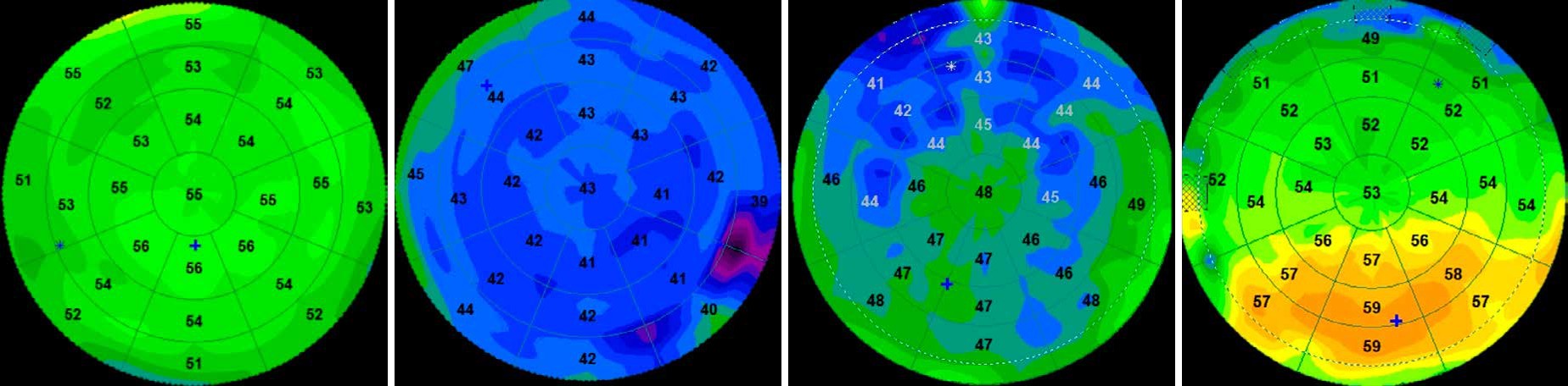 Classification de la s&eacute;cheresse oculaire par cartographie &eacute;pith&eacute;liale OCT : de la surface normale (vert) &agrave; la s&eacute;cheresse s&eacute;v&egrave;re (amincissement diffus)