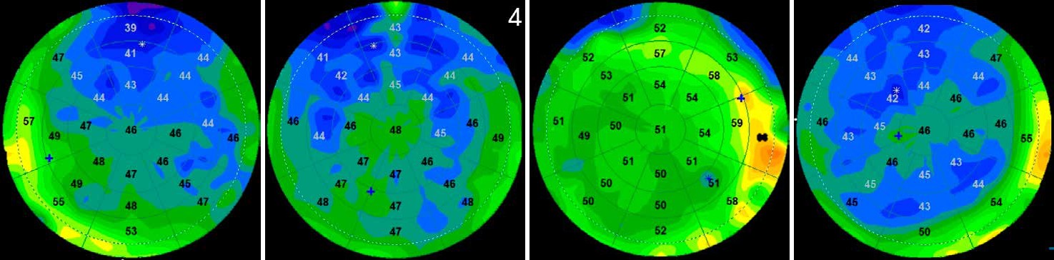 Suivi OCT avant et apr&egrave;s traitement IPL et photobiomodulation : am&eacute;lioration du profil &eacute;pith&eacute;lial
