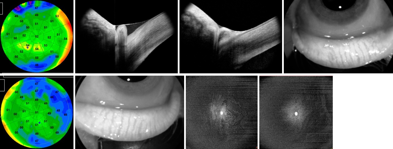 Multimodalit&eacute; par OCT de la s&eacute;cheresse oculaire : &eacute;pimapping, meibographie, OCT en face et m&eacute;nisque de larmes