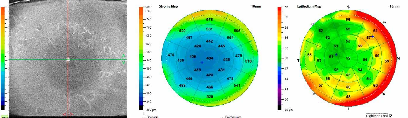 OCT en face du film lacrymal montrant l'instabilité de la couche lipidique et la correspondance en épimapping