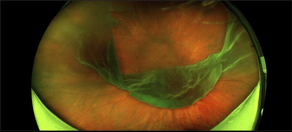 Photographie r&eacute;tinienne ultra-grand champ montrant une d&eacute;chirure g&eacute;ante de la r&eacute;tine avec inversion&nbsp;: le lambeau de r&eacute;tine d&eacute;coll&eacute;e, repli&eacute;, forme un voile clair au-dessus du fond de l'&oelig;il color&eacute; en rouge et vert.
