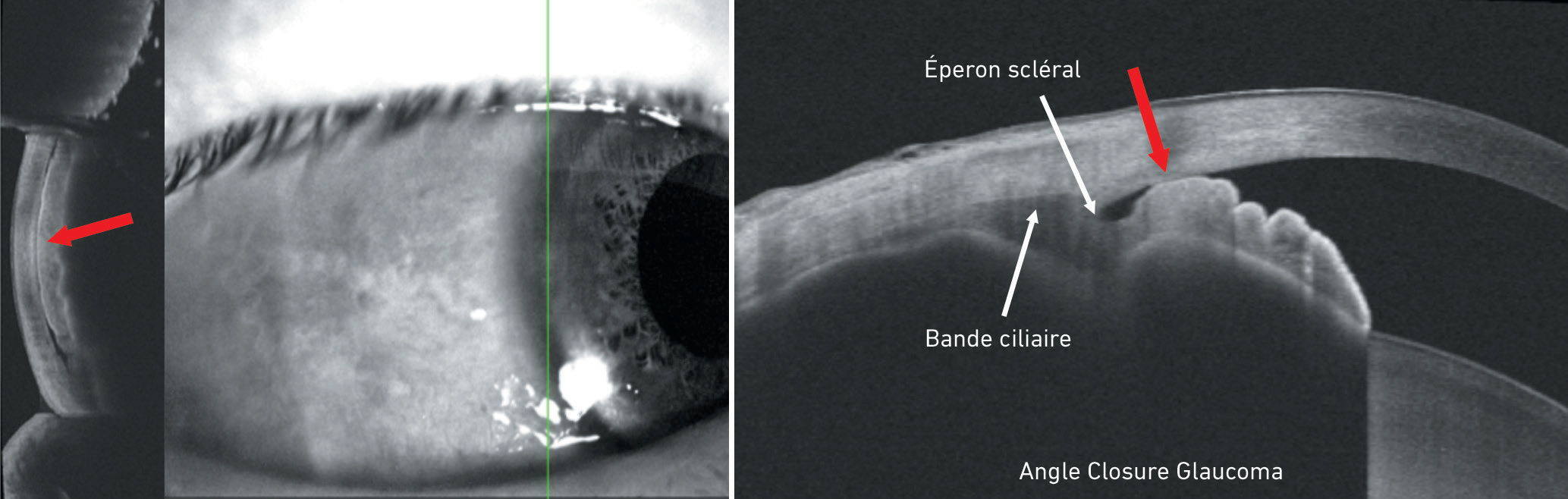 Analyse de l'angle de drainage de l'&oelig;il pour le d&eacute;pistage du glaucome