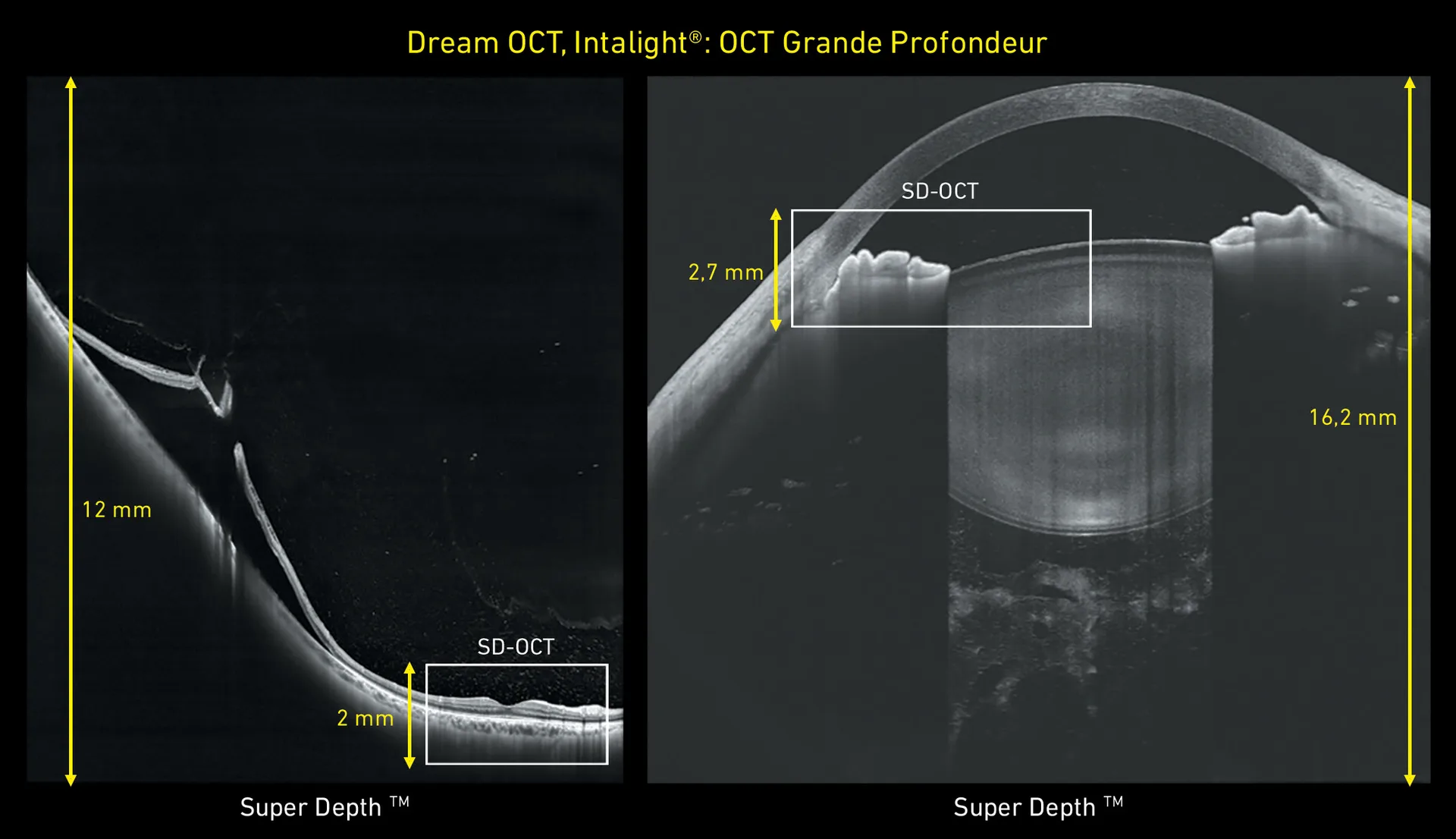 Dream OCT : comparaison de la profondeur d'acquisition entre le Dream OCT (12 et 16,2 mm) et un OCT classique (2 mm)