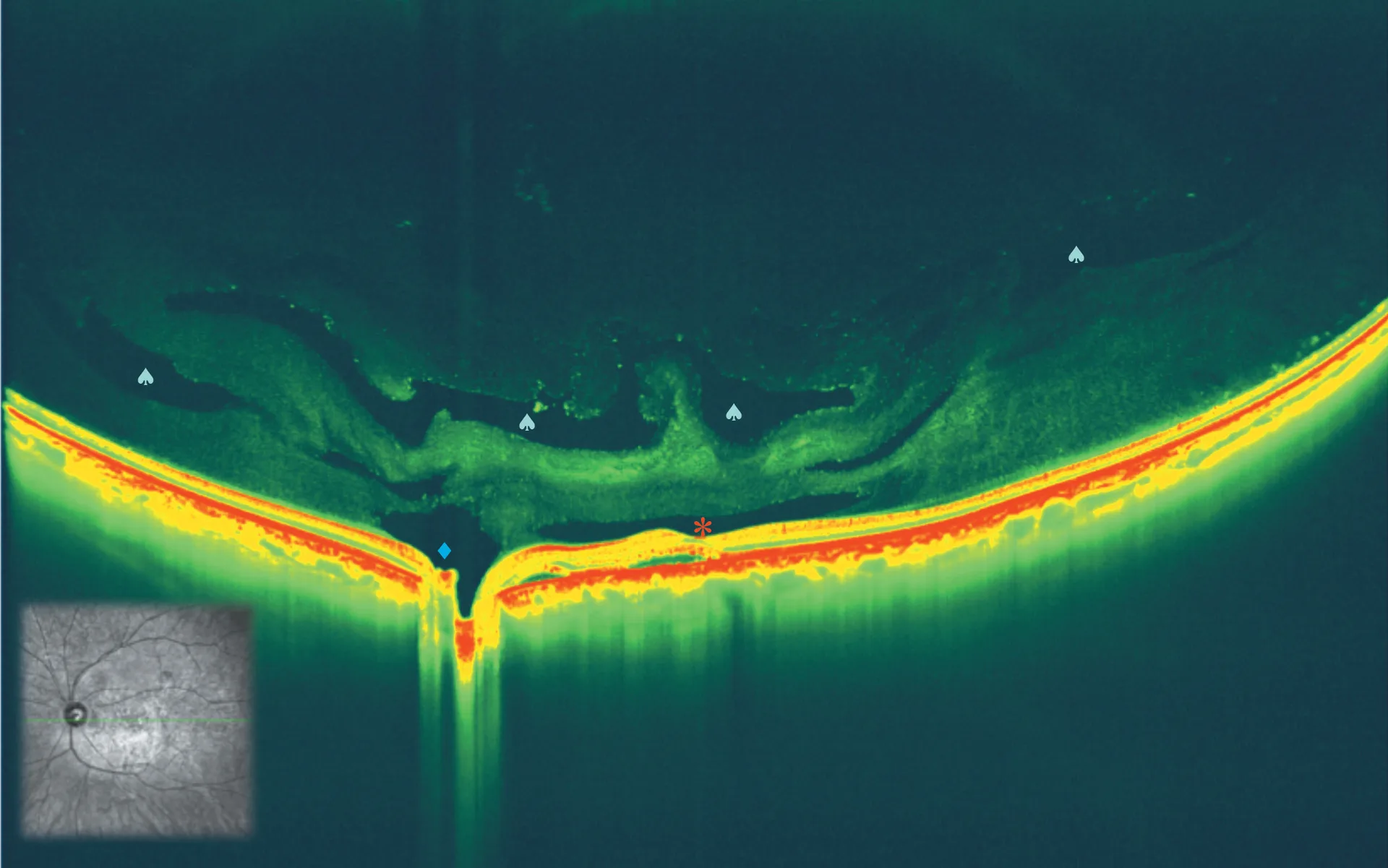 Imagerie OCT en couleurs du vitr&eacute; montrant les structures internes de l'&oelig;il