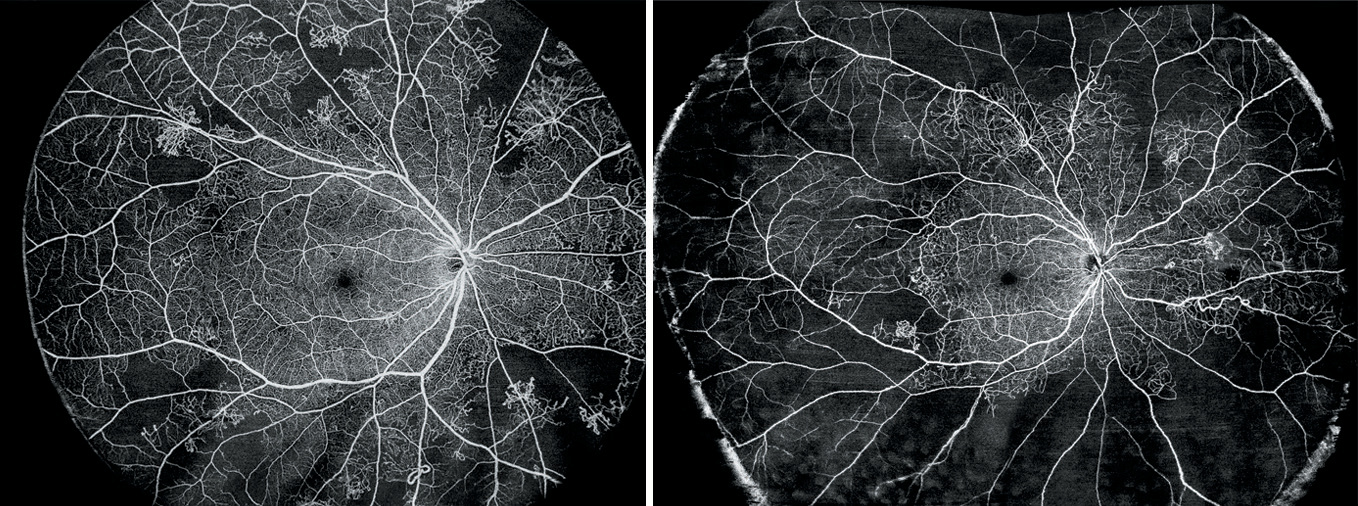 Cartographie OCTA des vaisseaux r&eacute;tiniens chez un patient diab&eacute;tique