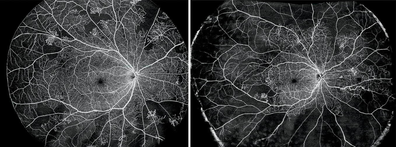 Cartographie OCTA des vaisseaux r&eacute;tiniens chez un patient diab&eacute;tique