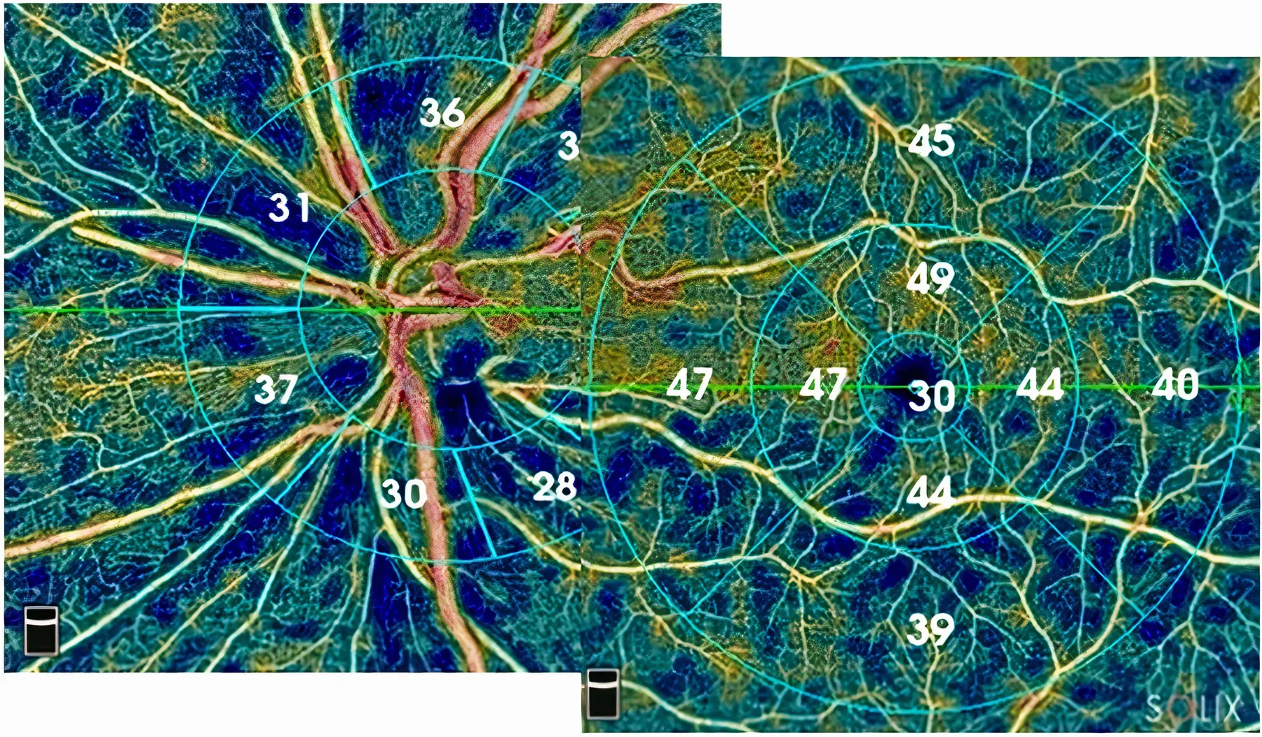 Image OCTA montrant la densit&eacute; vasculaire du nerf optique et de la macula chez un patient glaucomateux