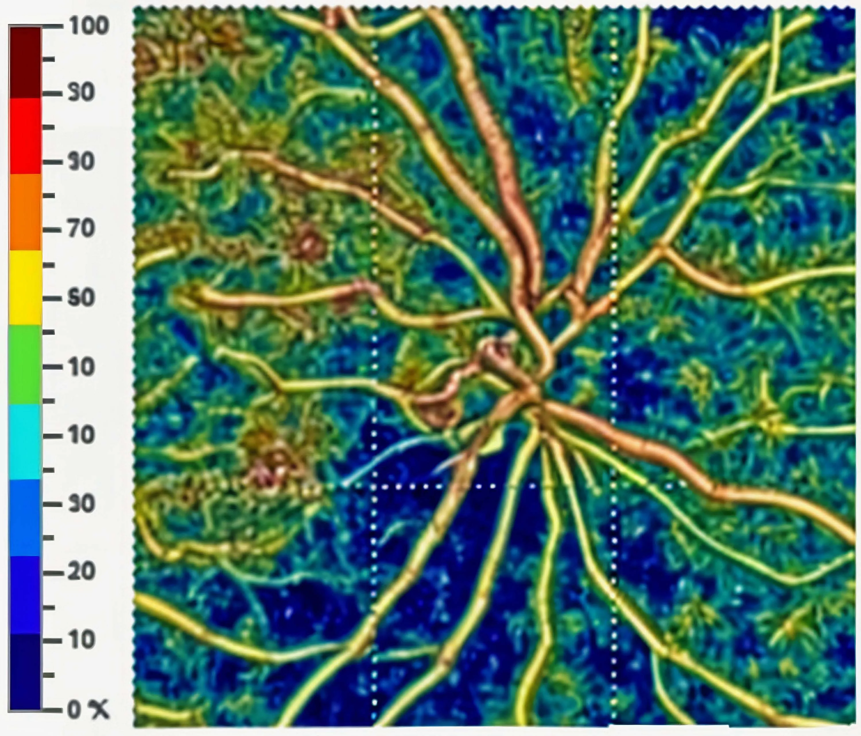 Cartographie de la densit&eacute; vasculaire du nerf optique en OCTA