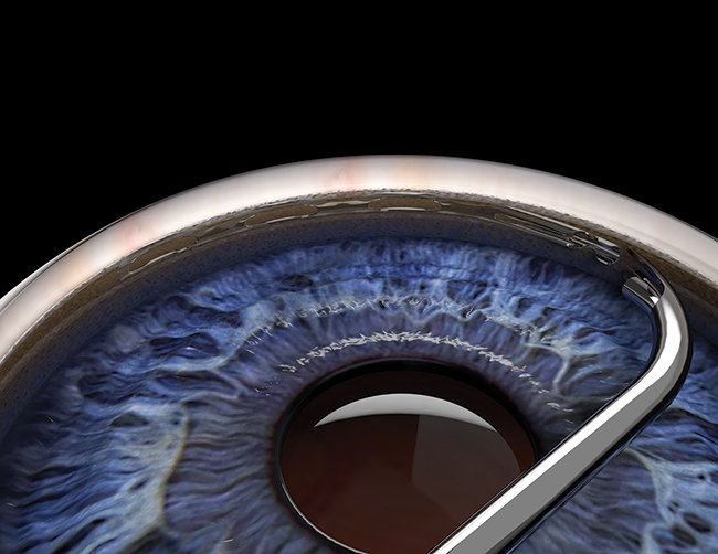 Hydrus Microstent&nbsp;: micro-&eacute;chafaudage en nitinol d&eacute;ploy&eacute; dans le canal de Schlemm pour le dilater et faciliter l'&eacute;vacuation de l'humeur aqueuse