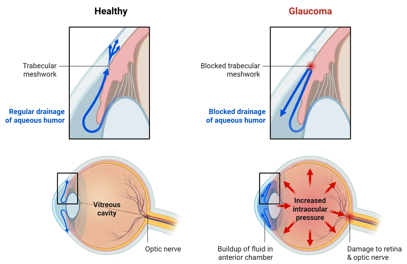 Schéma du glaucome : la pression intraoculaire comprime le nerf optique, entraînant une perte progressive des fibres nerveuses