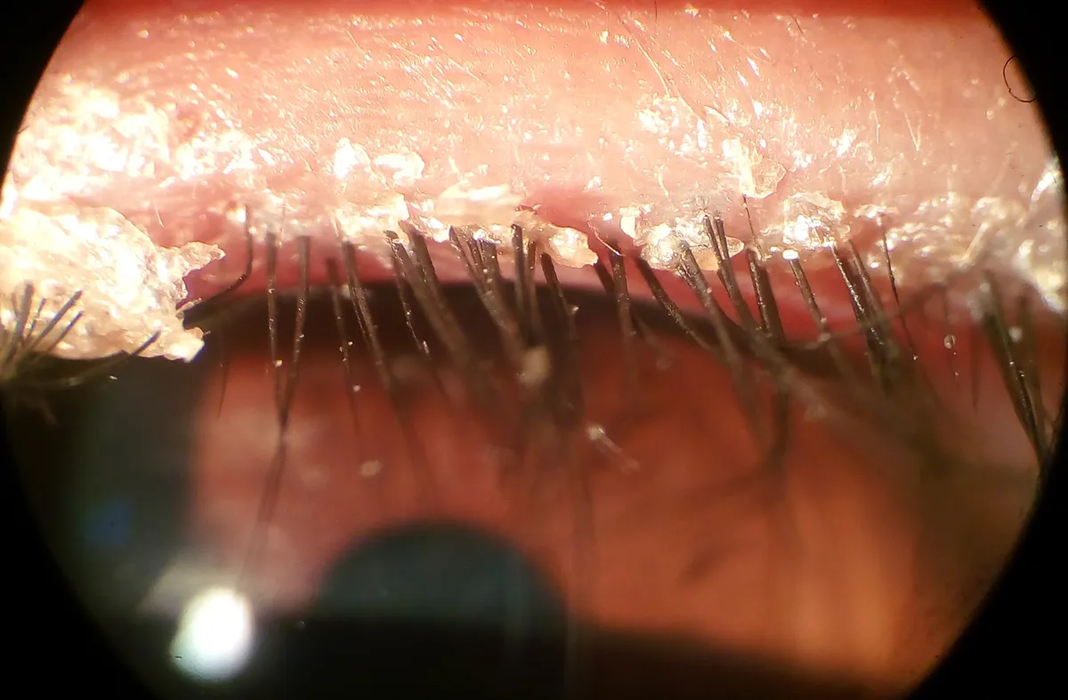 Blépharite antérieure séborrhéique avec croûtes à la base des cils