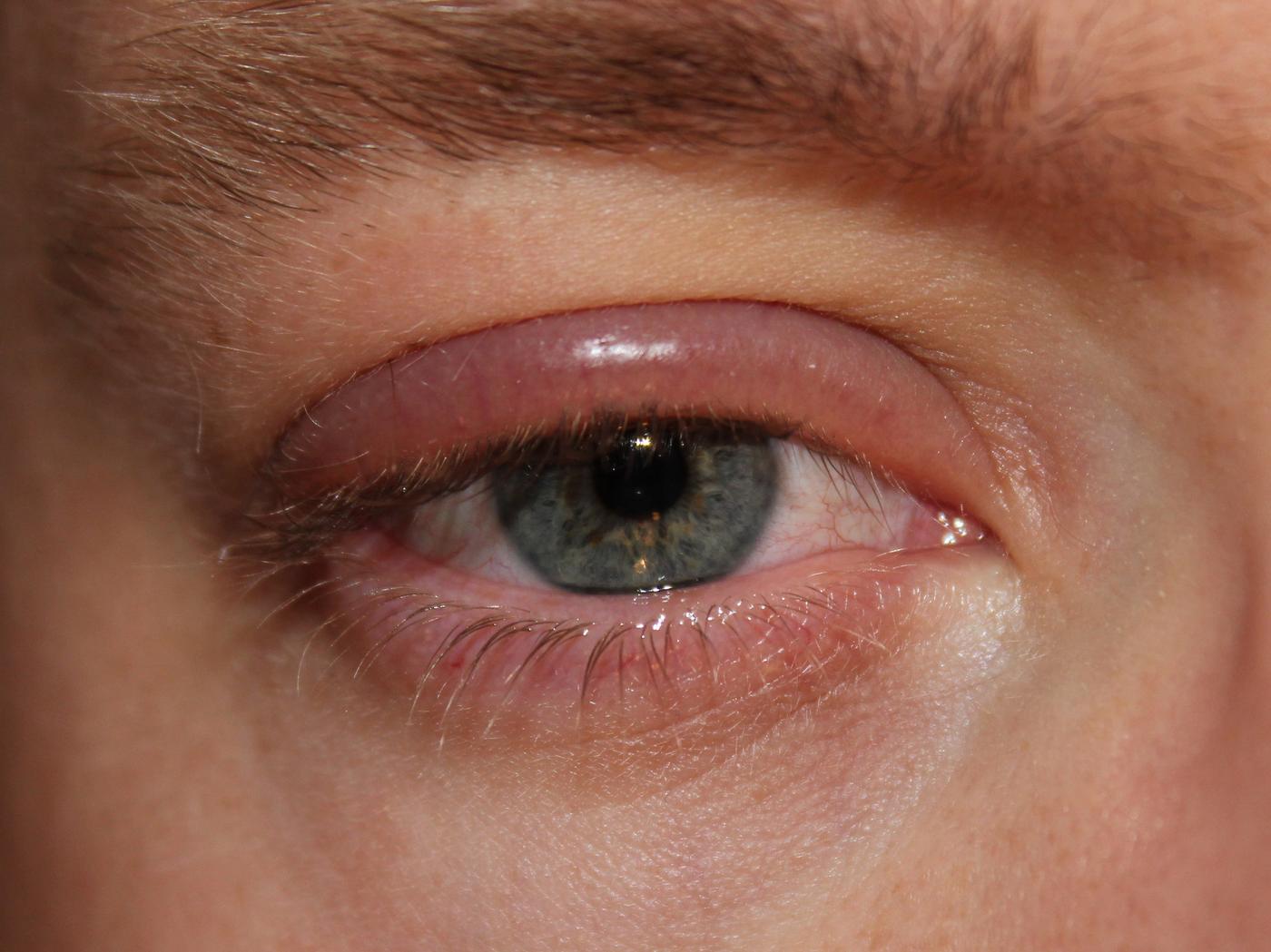 Blépharite : inflammation du bord libre de la paupière