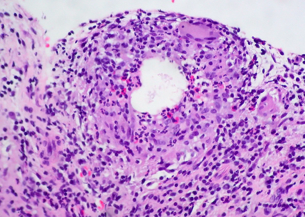 Histologie d'un chalazion : réaction lipogranulomateuse