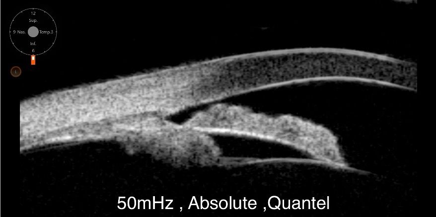 UBM 50 MHz d'un angle irido-cornéen étroit avec iris plateau et procès ciliaire antéropositionné