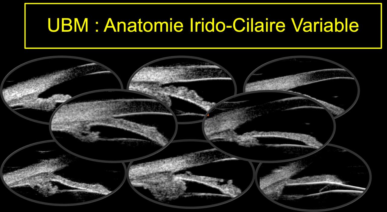 Variantes anatomiques de l'angle irido-ciliaire et du corps ciliaire en biomicroscopie ultrasonore (UBM 50 MHz)