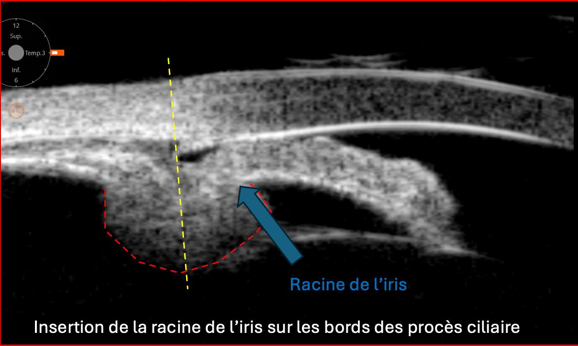 UBM annotée de l'insertion antérieure de la racine de l'iris sur les procès ciliaires, configuration d'angle étroit et d'iris plateau