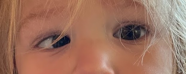Ésotropie accommodative chez un enfant