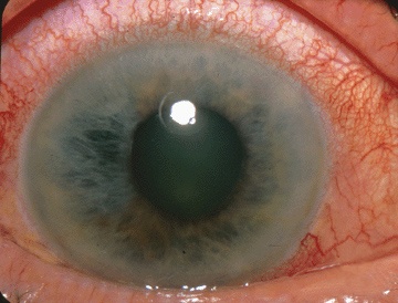 Photo clinique d'un glaucome aigu par fermeture de l'angle