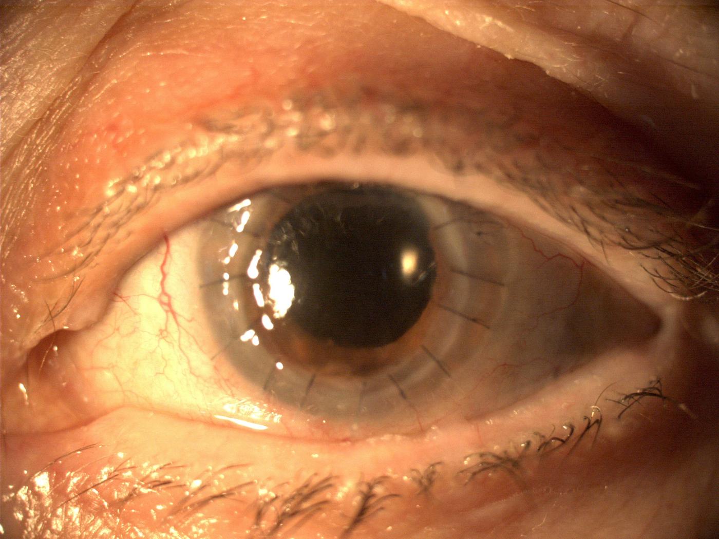 Kératoplastie transfixiante avec sutures visibles