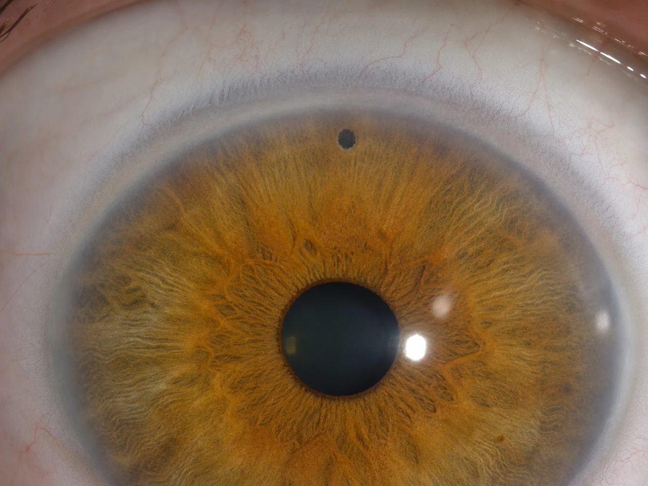 Iridotomie préventive au laser YAG : micro-orifice sombre créé dans l'iris périphérique supérieur (vers 12h), vu à la lampe à fente sur un iris brun