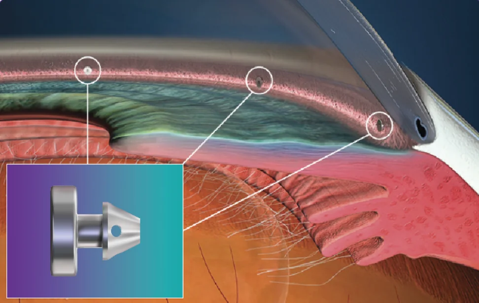 Illustration de l'implantation d'un iStent inject dans le trab&eacute;culum