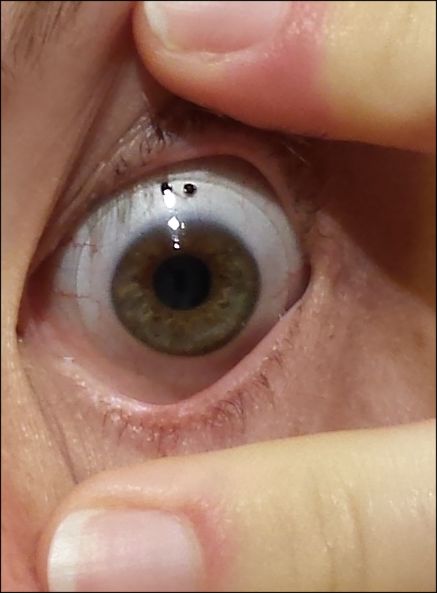Lentille sclérale portée sur l'œil