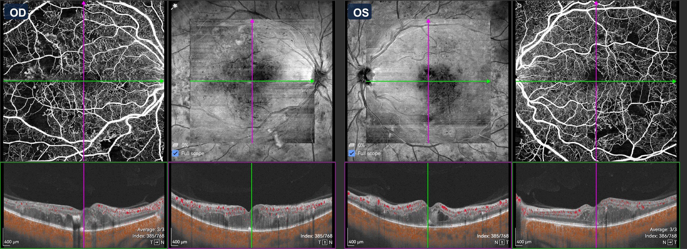 OCT-angiographie 9 x 9 mm des deux yeux chez un patient diabétique : cartes du réseau capillaire rétinien et coupes maculaires avec signal de flux