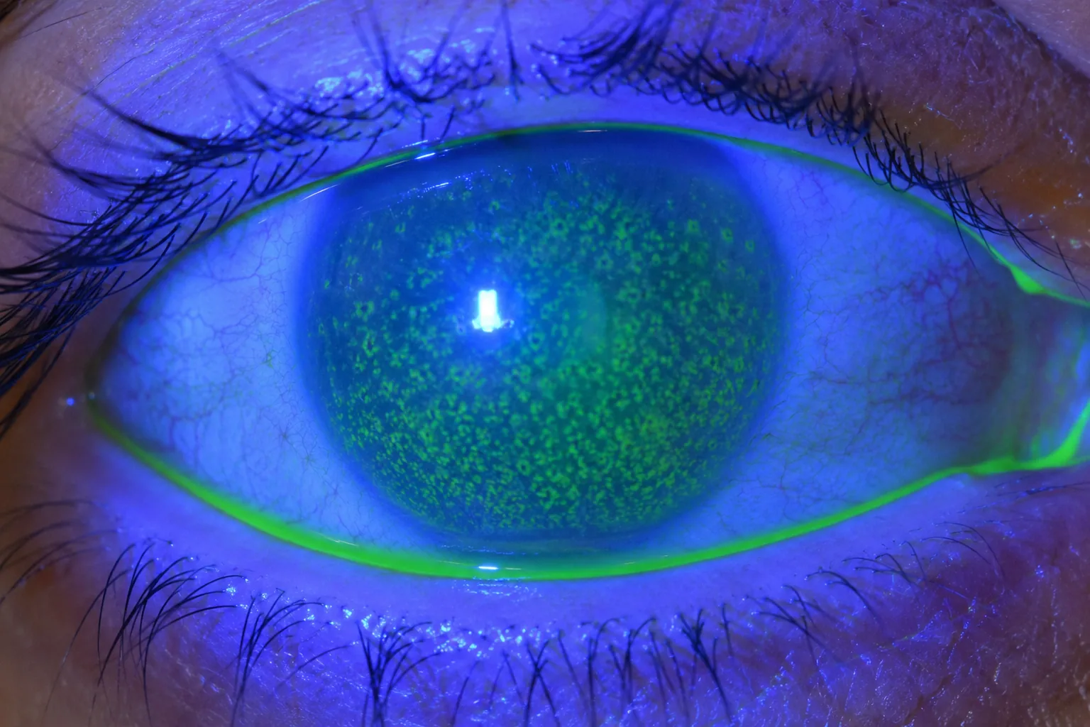 Coloration à la fluorescéine d'un œil sec : ponctuations vertes témoignant d'une kératite ponctuée superficielle