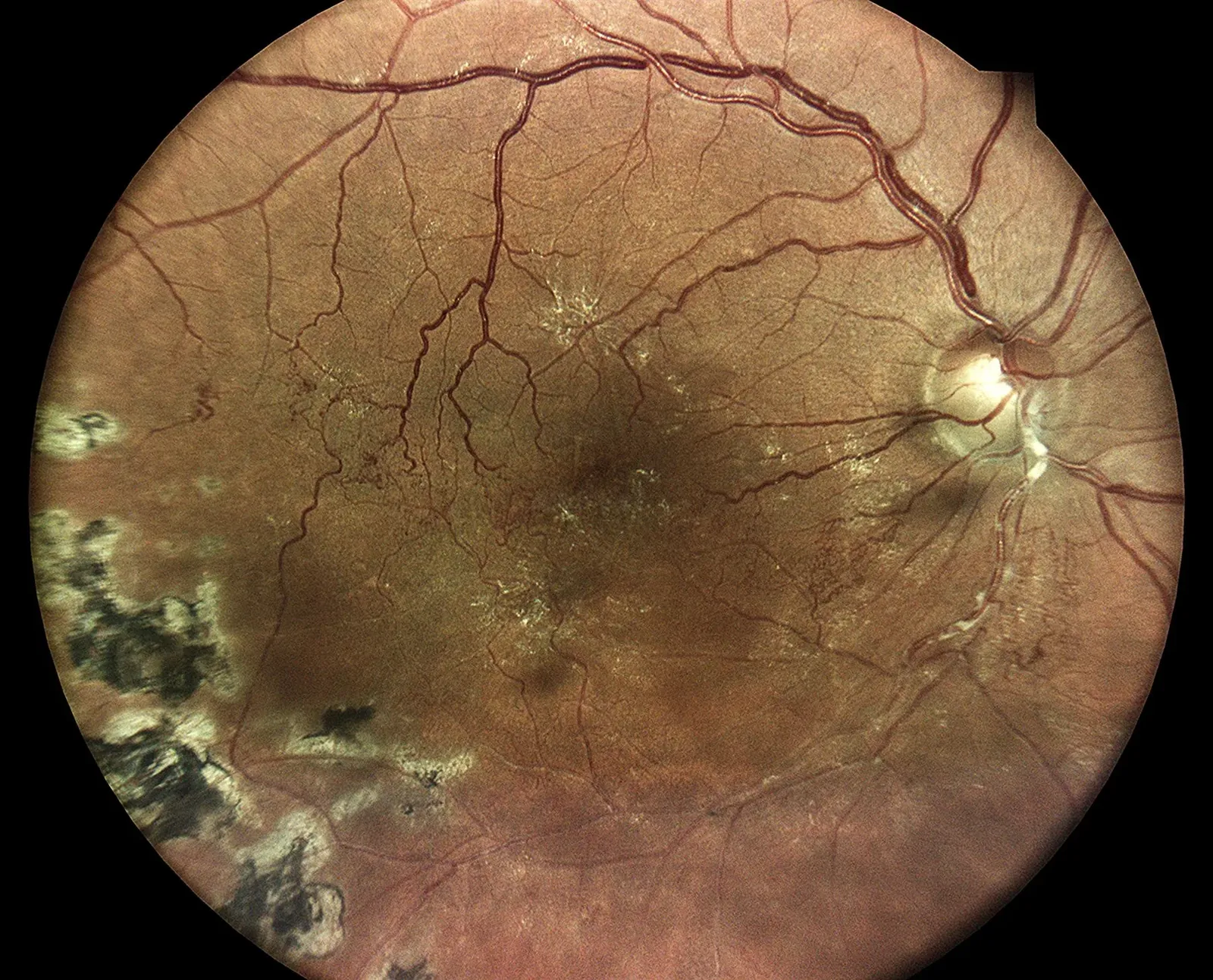 OBVR au stade chronique après photocoagulation laser argon