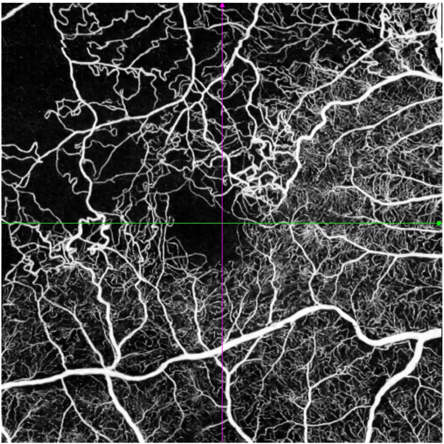 OCT-angiographie grand champ Intalight montrant une raréfaction capillaire séquellaire