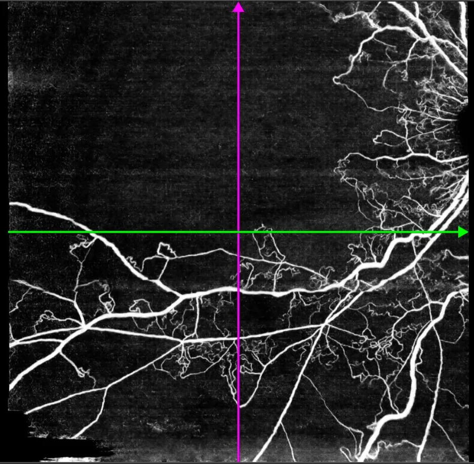 OCT-angiographie zoom sur la zone avasculaire