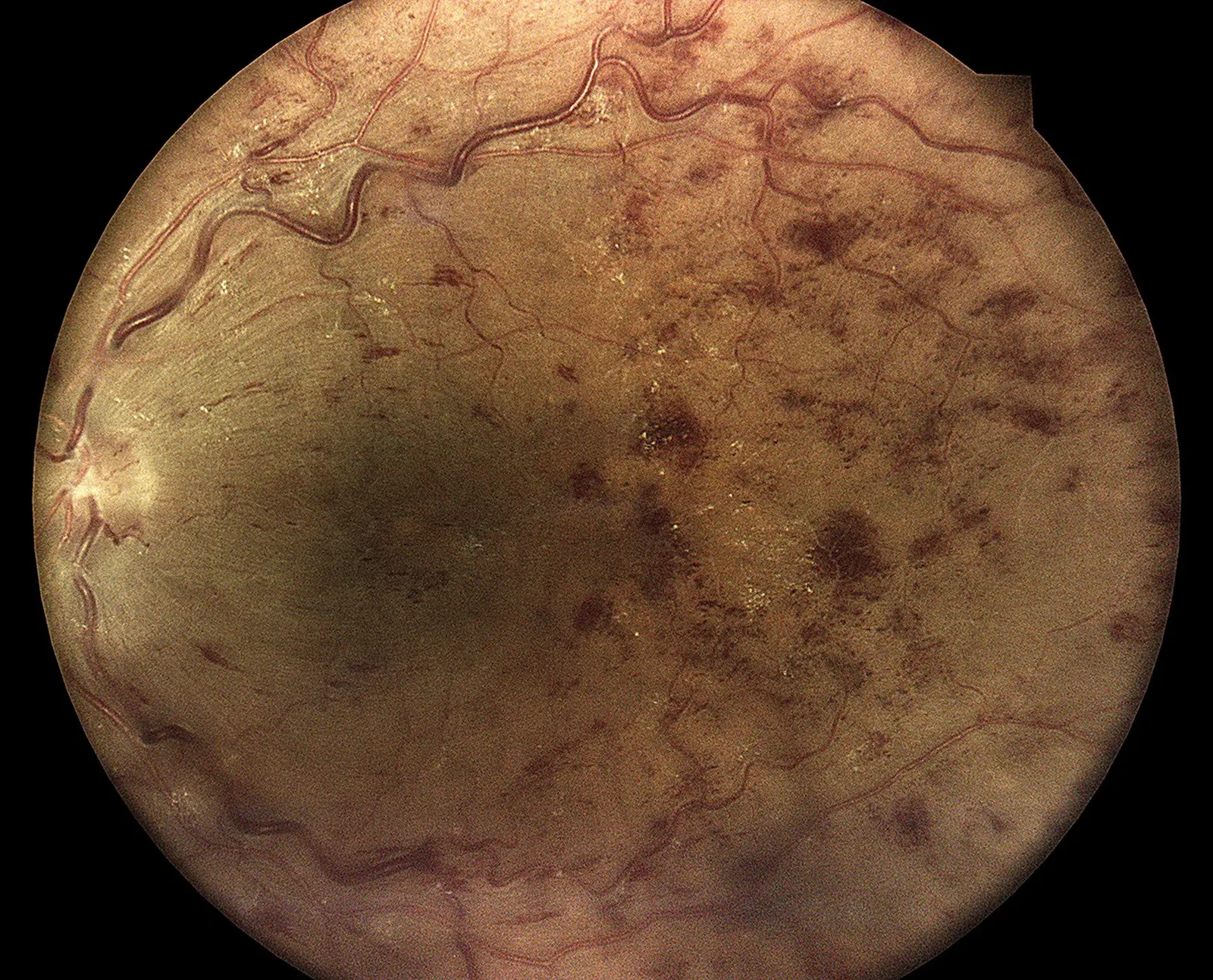 Occlusion de la veine centrale de la rétine aiguë : hémorragies diffuses et veines tortueuses