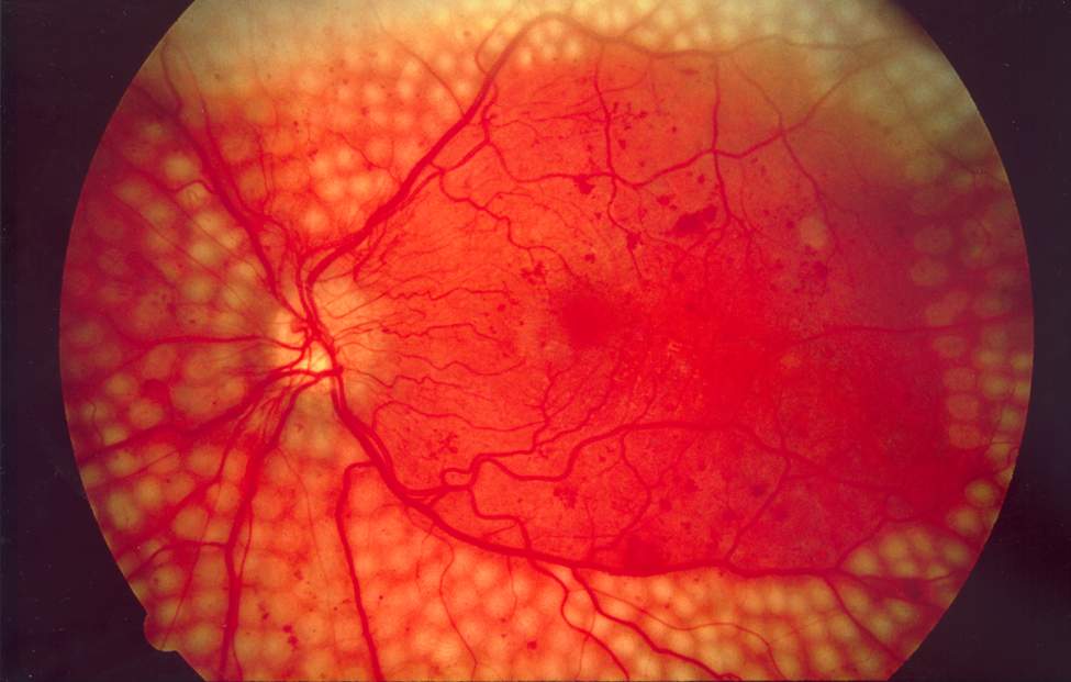 Fond d'œil après photocoagulation panrétinienne