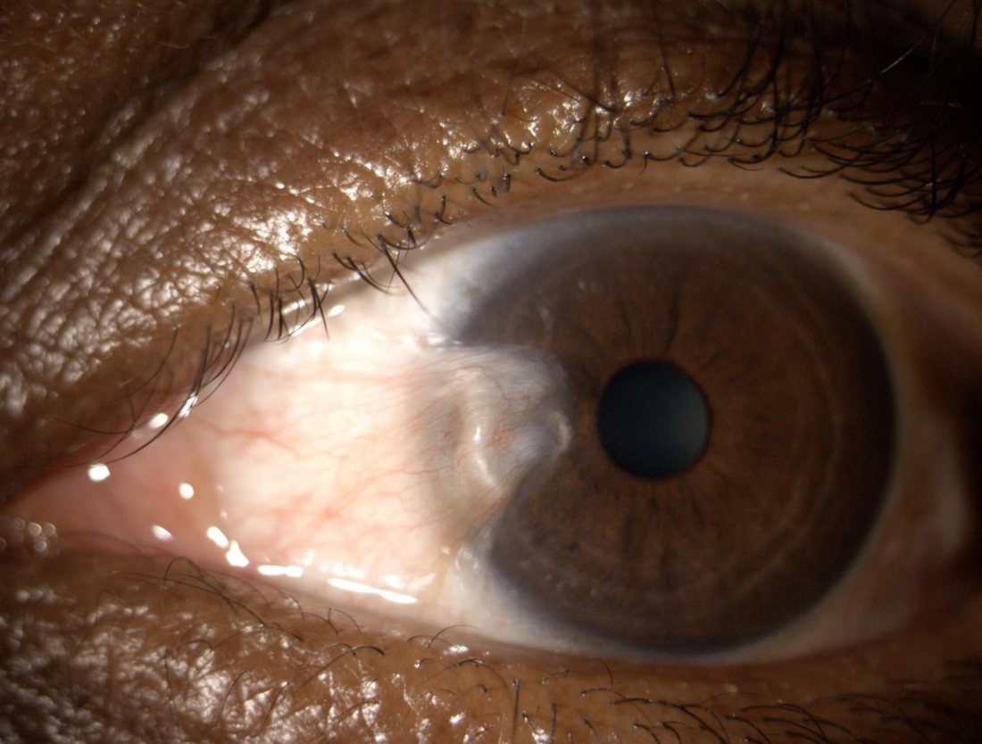 Photographie clinique d'un pt&eacute;rygion nasal : membrane fibrovasculaire triangulaire empi&eacute;tant sur la corn&eacute;e vers la pupille