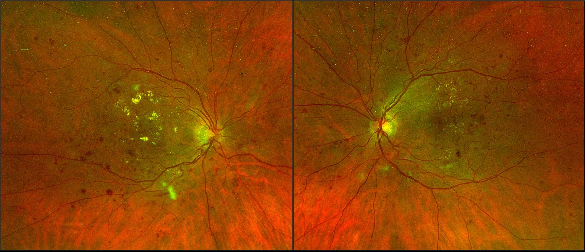 Rétinographie grand champ des deux yeux : rétinopathie diabétique avec exsudats secs jaunes autour de la macula et hémorragies rétiniennes en tache