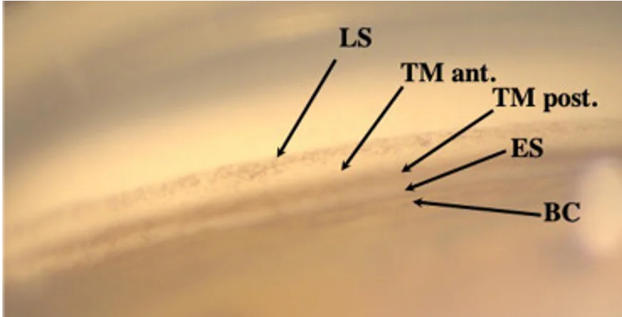 Vue gonioscopique de l'angle irido-cornéen lors d'un traitement SLT montrant le trabéculum