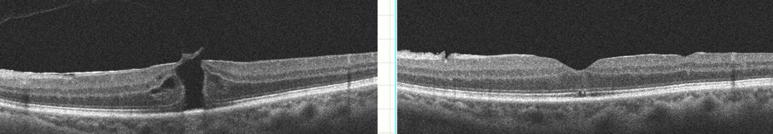 OCT d'un trou maculaire opéré chez un myope fort — IPO Paris