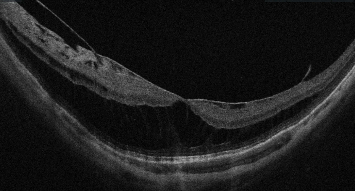 OCT maculaire montrant un fovéoschisis du myope fort — clivage des couches rétiniennes internes et externes au niveau fovéolaire
