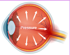 Schéma de l'hypertonie oculaire : augmentation de la pression intraoculaire par blocage de l'évacuation de l'humeur aqueuse