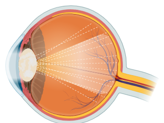 Simulation visuelle de l'effet d'une cataracte : vision normale à gauche, vision voilée et floue à droite